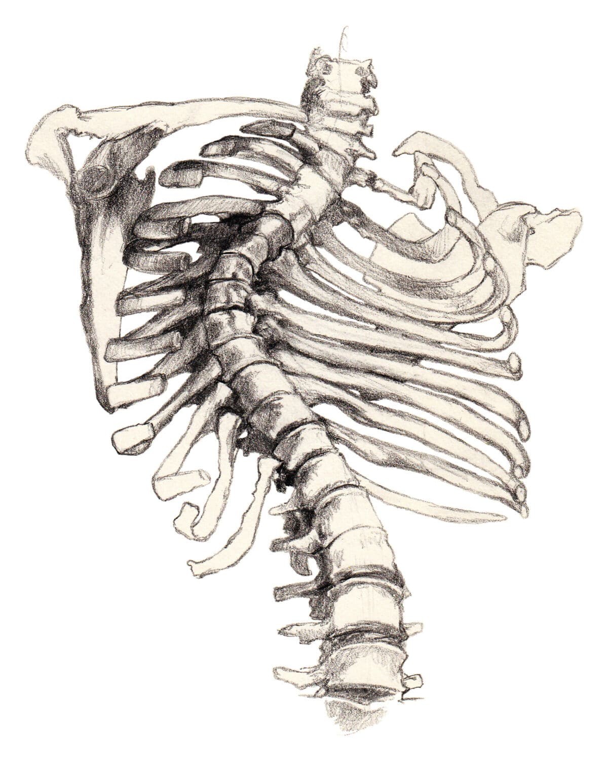 Cartoon drawing of a rib cage and spine. The spine is curved from scoliosis.