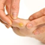 Close-up of a foot callus, highlighting the yellowed, thickened skin