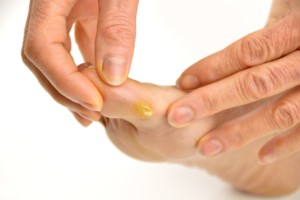 Close-up of a foot callus, highlighting the yellowed, thickened skin