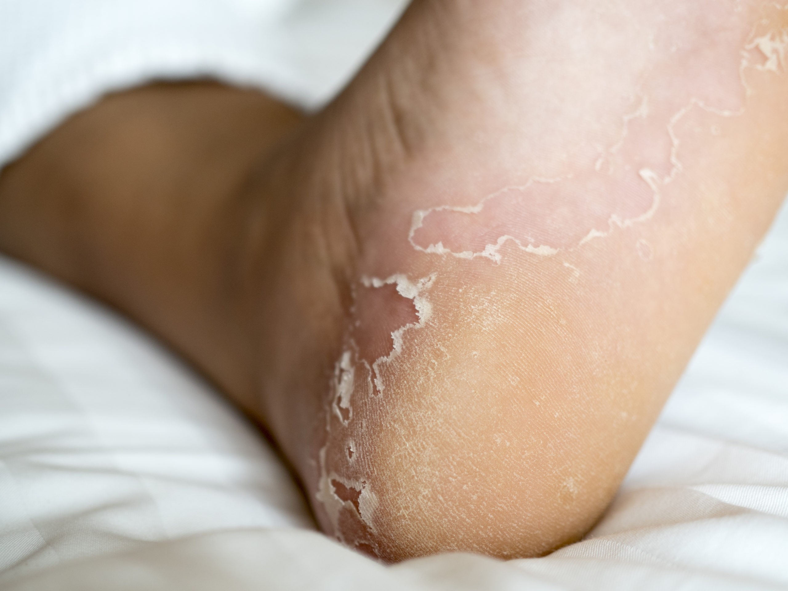 Close-up of a heel with dry, peeling skin, illustrating a common foot skin condition