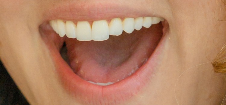 Close-up of a white tongue showing coated papillae