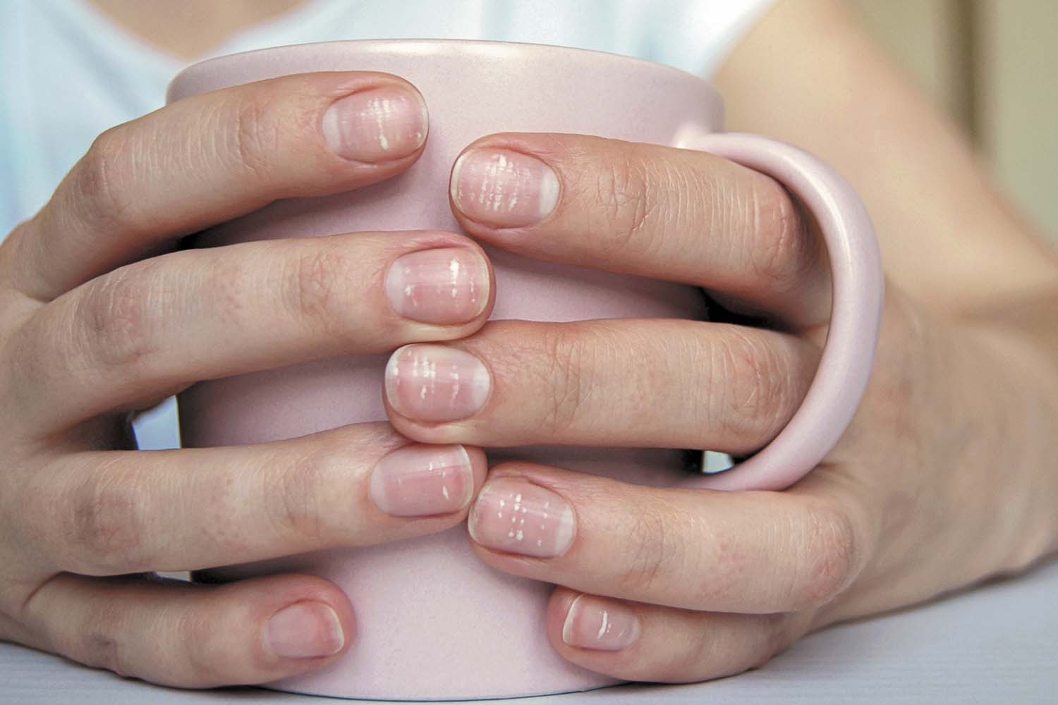 Close-up of fingernails showing common white spots, a condition also known as leukonychia, often caused by minor nail trauma.