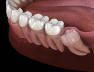 Dental X-Ray Showing Wisdom Teeth