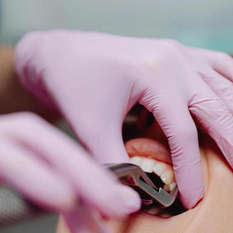 Dentist performing a tooth extraction, a potential solution for severe dental issues causing pain when biting down.