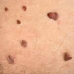 Image of multiple skin tags.