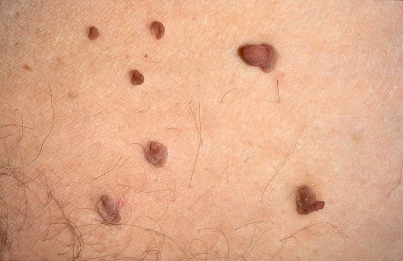 Image of multiple skin tags.