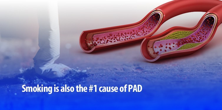 Smoking is number 1 cause of PAD