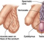 varicocele diagram