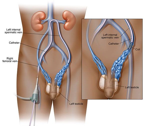 Varicocele Embolization Illustration