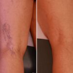 Varicose veins before and after treatment, showing the reduction of bulging veins after medical intervention