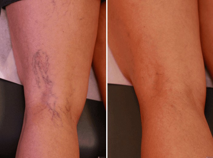 Varicose veins before and after treatment, showing the reduction of bulging veins after medical intervention