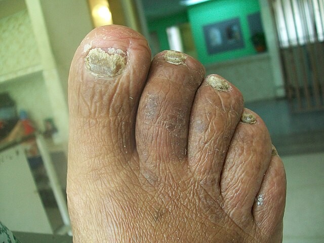 Yellow Toenail Fungus