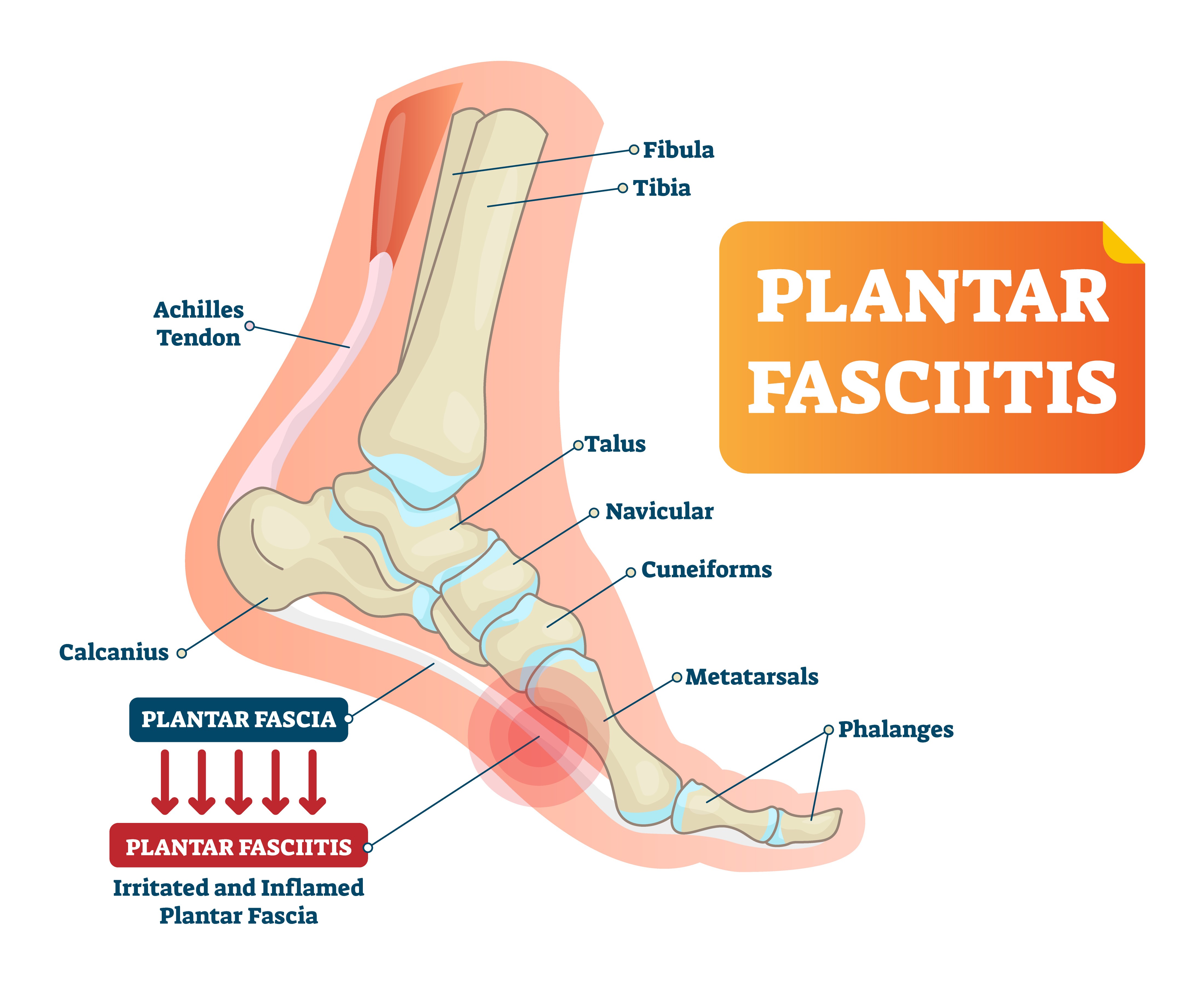 Plantar fasciitis is characterized by pain in the arch of the foot.