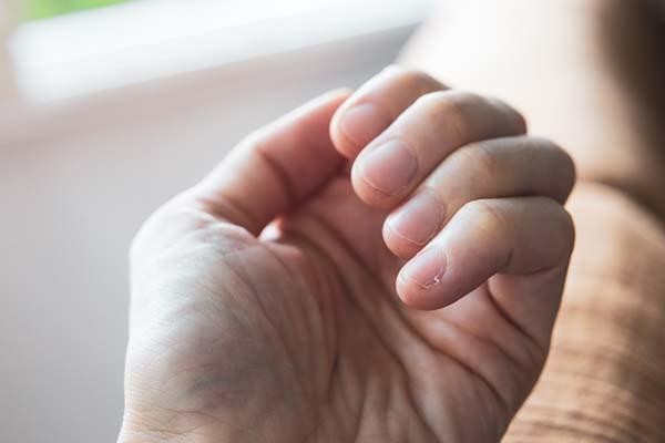 A close-up of a person's hand showing a hangnail on their ring finger. The skin around the nail appears dry and slightly red.